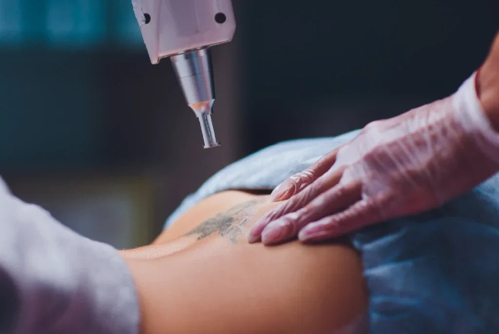 Eliminación de tatuajes